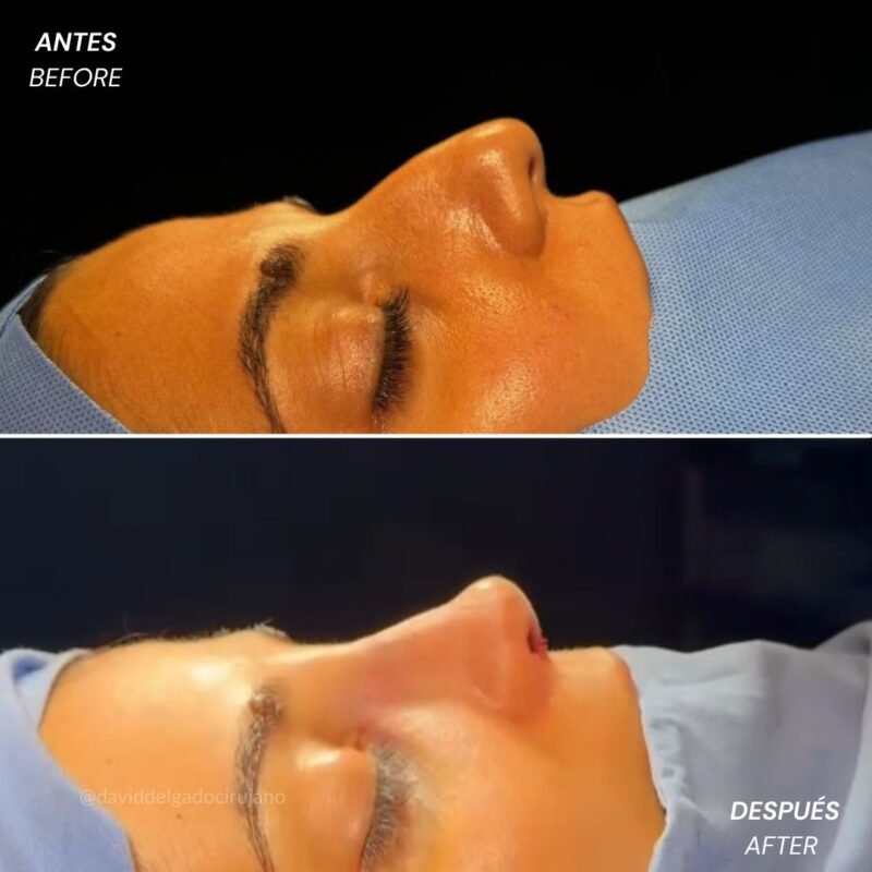 Rinoplastia Ultrasónica Antes y Después