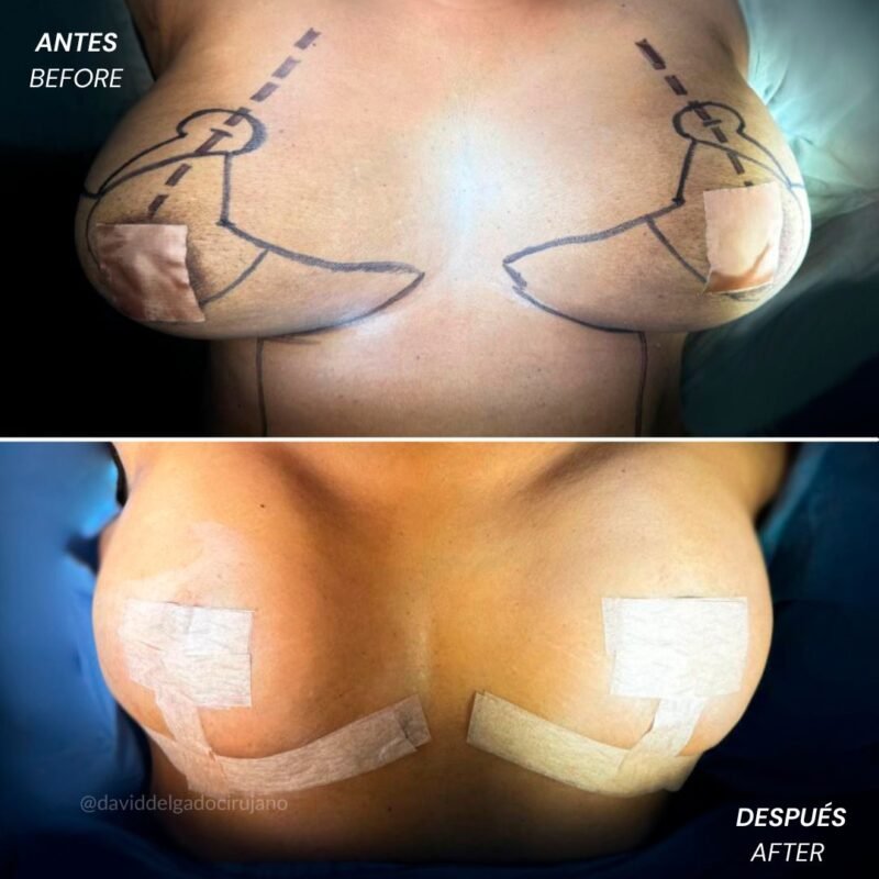 Mastopexia sin Implantes Antes y Después