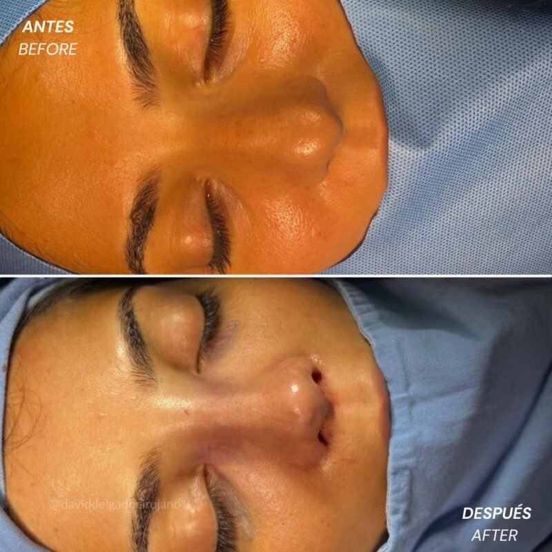 Rinoplastia Ultrasónica Antes y Después