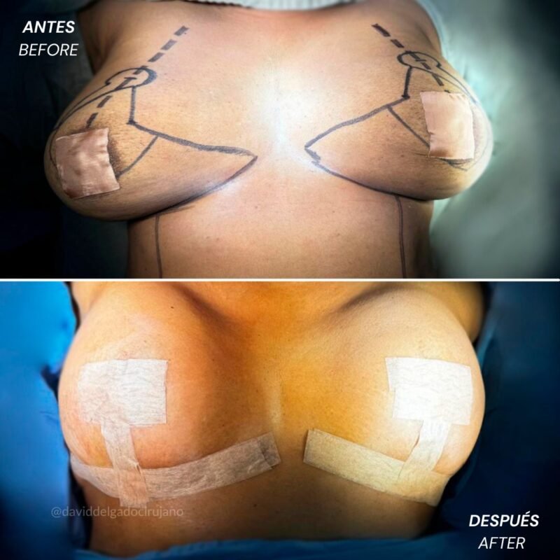 Mastopexia sin Implantes Antes y Después