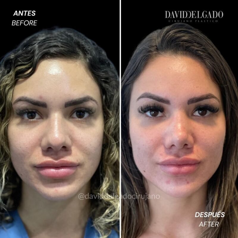 Rinoplastia Antes y Después