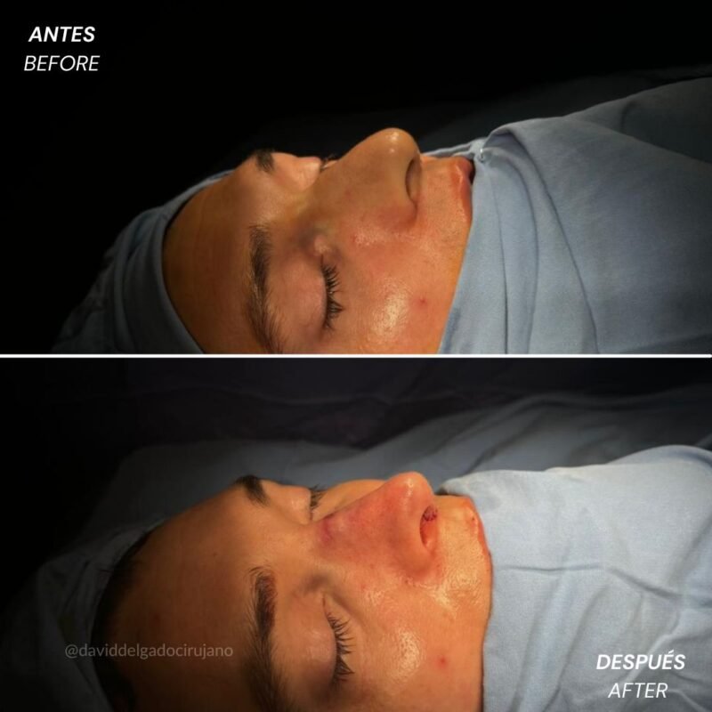 Rinoplastia Antes y Después