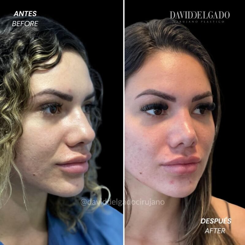 Rinoplastia Antes y Después