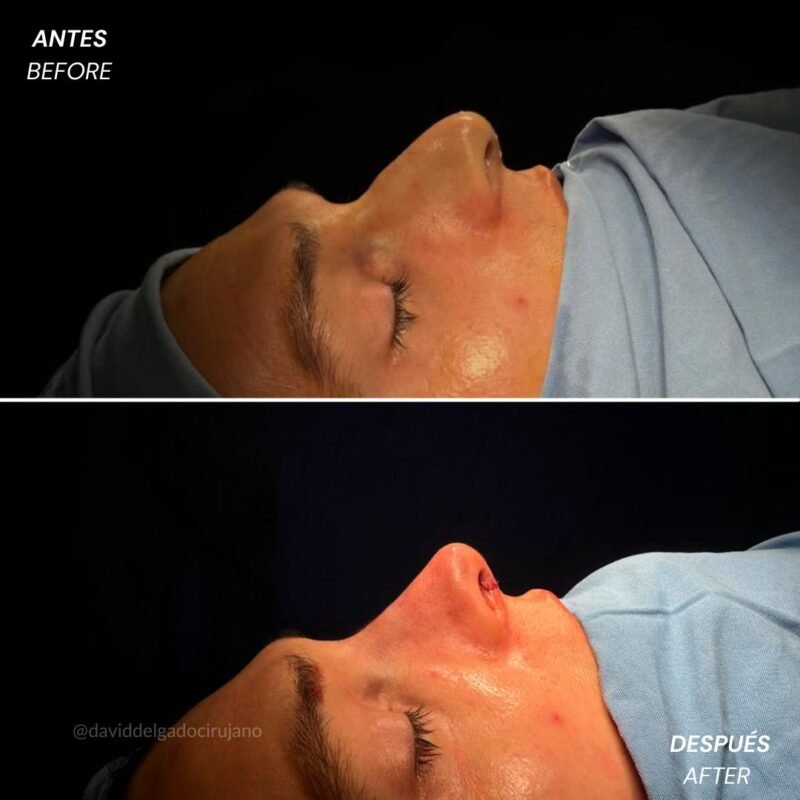 Rinoplastia Antes y Después