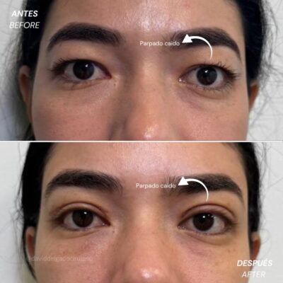 Antes y Después Blefaroplastia | Dr. David Delgado Cirujano Plástico Medellín