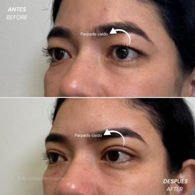 Antes y Después Blefaroplastia | Dr. David Delgado Cirujano Plástico Medellín