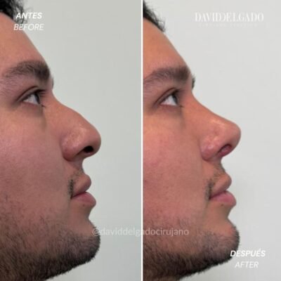 Antes y después Rinoplastia Ultrasónica | David Delgado Cirujano