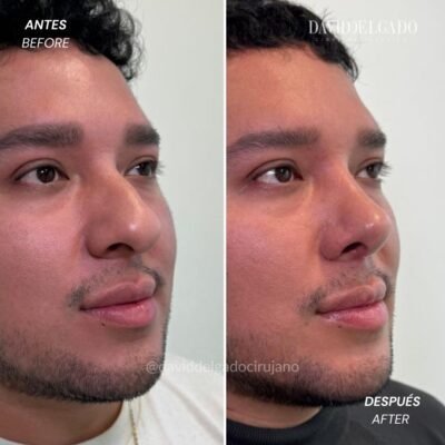 Antes y después Rinoplastia Ultrasónica | David Delgado Cirujano