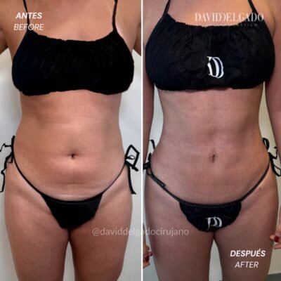 Antes y Después Liposucción 360 | David Delgado Cirujano