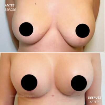 Antes y después Mastopexia en T - Dr. David delgado Cirujano Plástico en Medellín