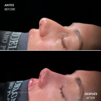 Antes y después Rinoplastia Ultrasónica Dr. David delgado Cirujano Plástico en Medellín