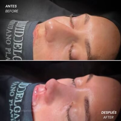 Antes y después Rinoplastia Ultrasónica Dr. David delgado Cirujano Plástico en Medellín