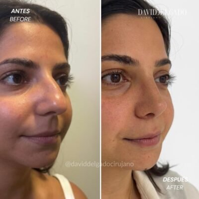 Antes y después Rinoplastia Ultrasónica Dr. David delgado Cirujano Plástico en Medellín