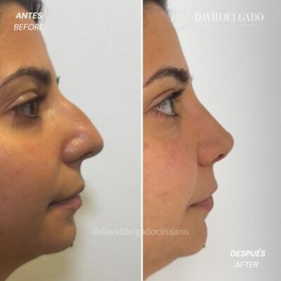 Antes y después Rinoplastia Ultrasónica Dr. David delgado Cirujano Plástico en Medellín