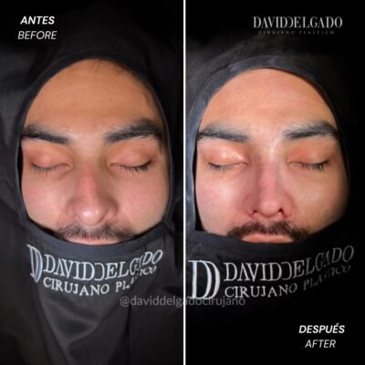 Antes y después Rinoplastia Ultrasónica Dr. David delgado Cirujano Plástico en Medellín