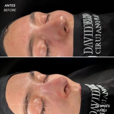 Antes y después Rinoplastia Ultrasónica Dr. David delgado Cirujano Plástico en Medellín