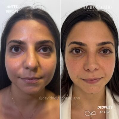 Antes y después Rinoplastia Ultrasónica Dr. David delgado Cirujano Plástico en Medellín