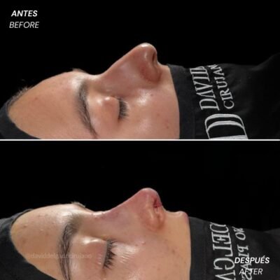Antes y después Rinoplastia Ultrasónica Dr. David delgado Cirujano Plástico en Medellín
