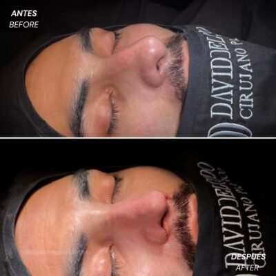 Antes y después Rinoplastia Ultrasónica Dr. David delgado Cirujano Plástico en Medellín