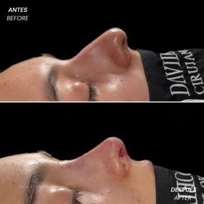 Antes y después Rinoplastia Ultrasónica Dr. David delgado Cirujano Plástico en Medellín