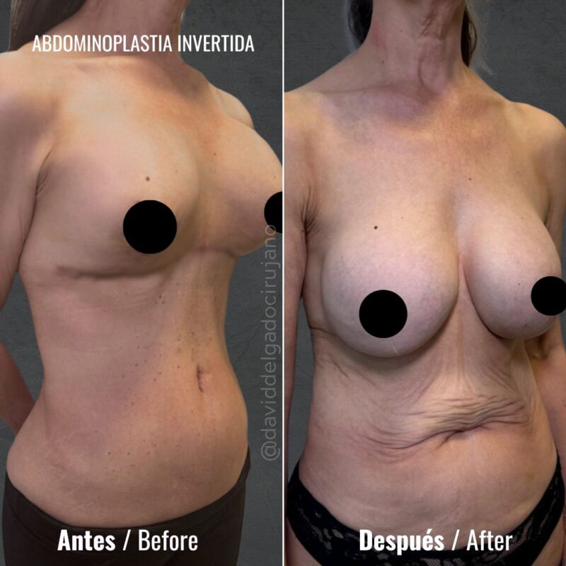 Abdominoplastia inversa fotos - Dr. David Delgado - Cirujano plástico en Medellín