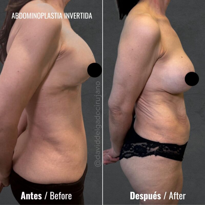 Abdominoplastia invertida antes y después - Dr. David Delgado