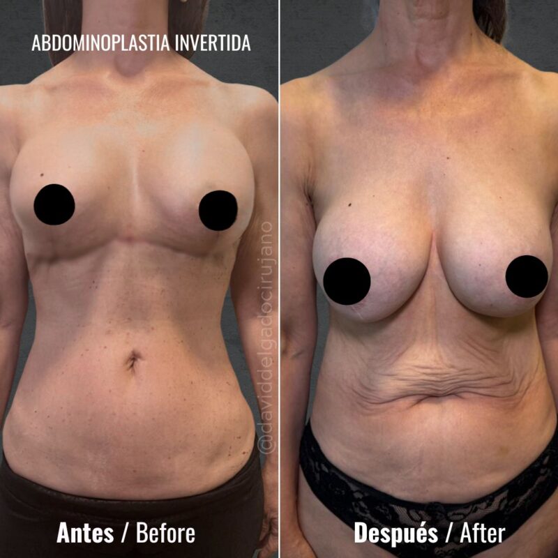 Abdominoplastia reversa cicatriz - Dr. David Delgado - Cirujano plástico en Medellín