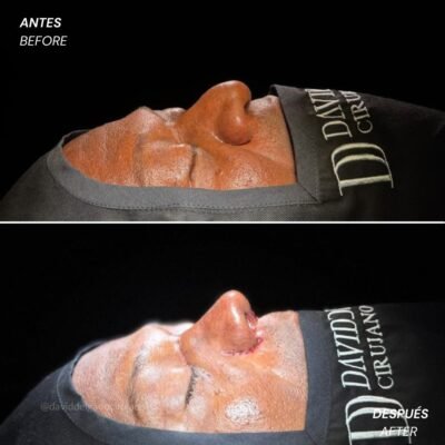 Antes y después Rinoplastia Dr. David delgado Cirujano Plástico en Medellín