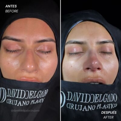 Antes y después Rinoplastia Ultrasónica Dr. David delgado Cirujano Plástico en Medellín