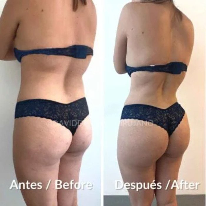 Antes y después Dr. David Delgado Abdominoplastia Lipo Inyección glutea