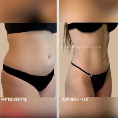 Antes y después Dr. David Delgado Abdominoplastia Liposucción con marcación abdominal