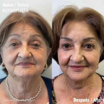 Antes y después Dr. David Delgado Blefaroplastia