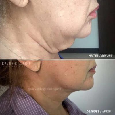 Antes y después Dr. David Delgado Cervicoplastia