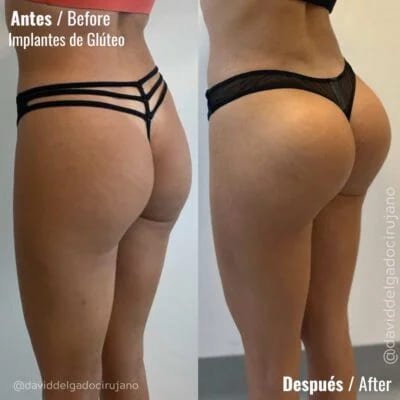 Antes y después Dr. David Delgado Gluteoplastia