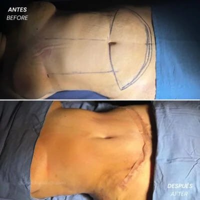 Antes y después Dr. David Delgado Lipo Abdominoplastia