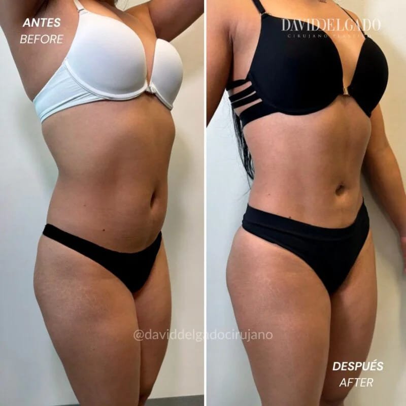 Antes y después Dr. David Delgado Liposucción