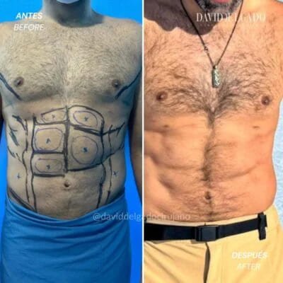 Antes y después Dr. David Delgado Marcación Abdominal Hombre