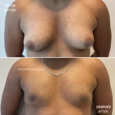 Antes y después Dr. David Delgado Masculinización del torax