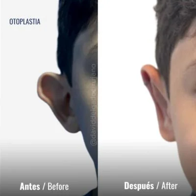 Antes y después Dr. David Delgado Otoplastia