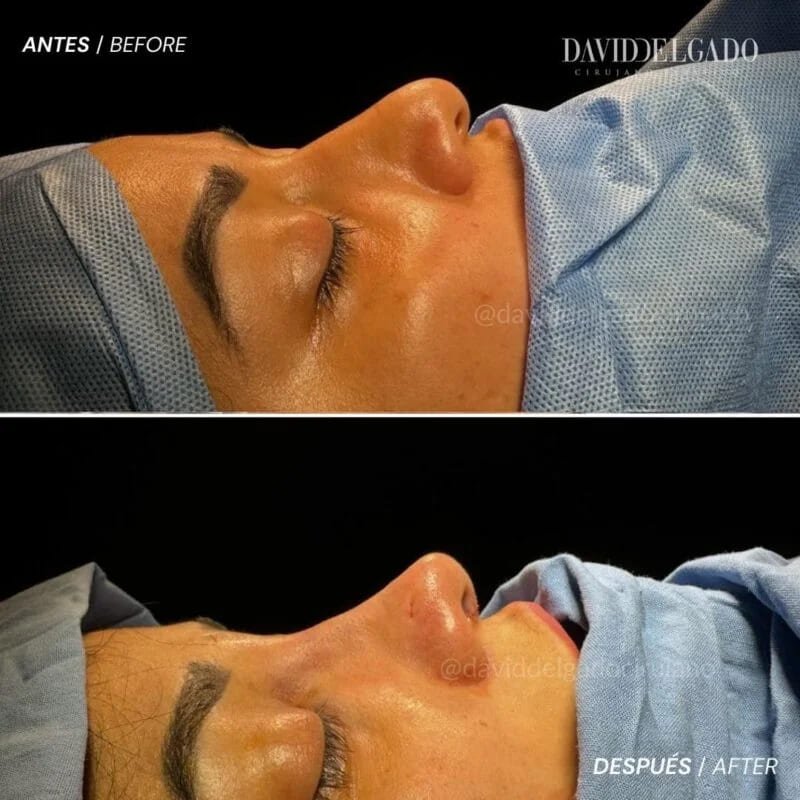 Antes y después Dr. David Delgado Rinoplastia Ultrasonica