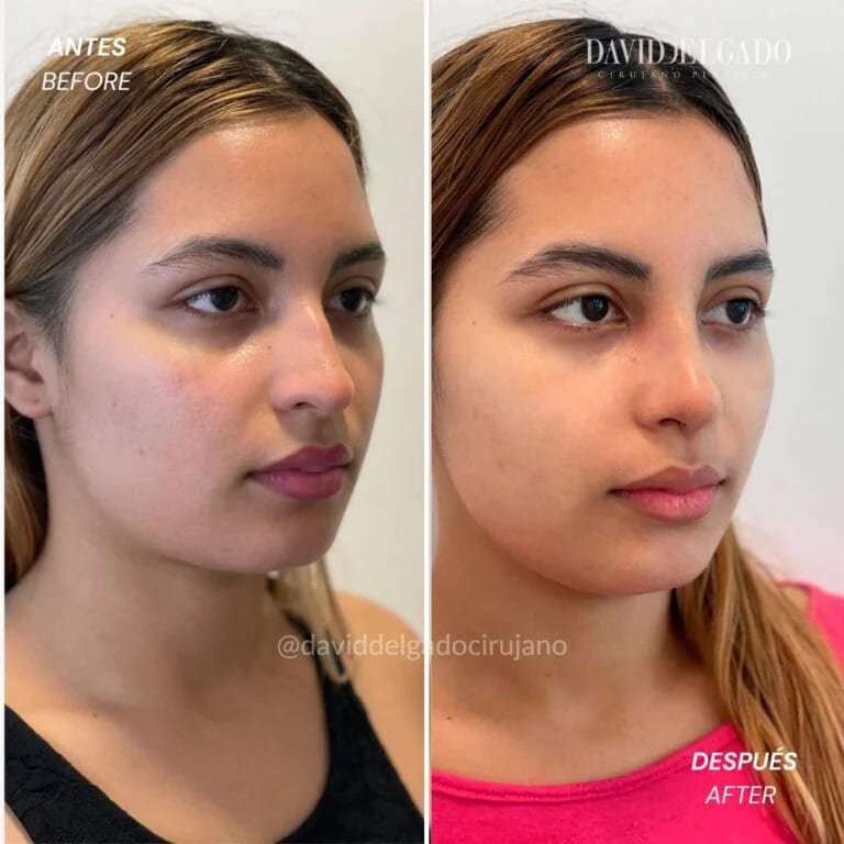 Antes y después Dr. David Delgado Rinoplastia