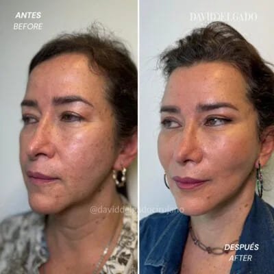 Antes y después Dr. David Delgado Ritidoplastia
