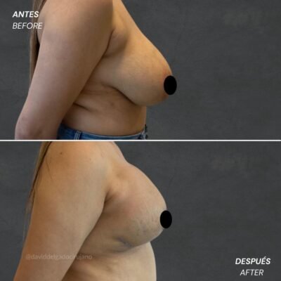 Antes y después Mastopexia sin implantes Dr. David delgado Cirujano Plástico en Medellín