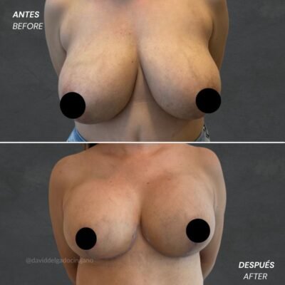 Antes y después Mastopexia sin implantes Dr. David delgado Cirujano Plástico en Medellín