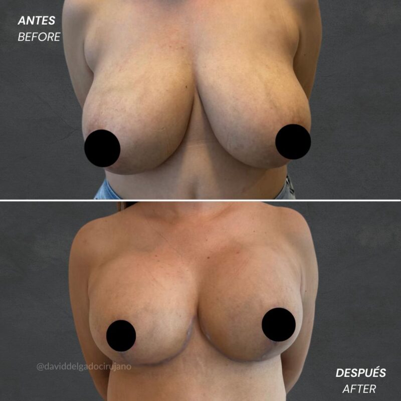 Antes y después Mastopexia sin implantes Dr. David delgado Cirujano Plástico en Medellín