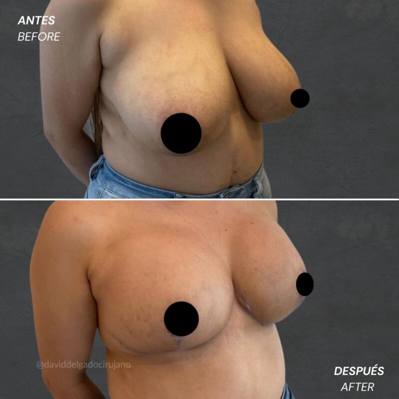 Antes y después Mastopexia sin implantes Dr. David delgado Cirujano Plástico en Medellín