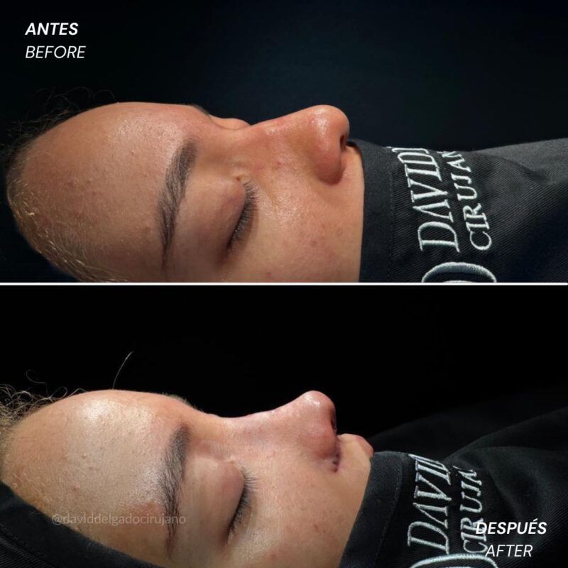Antes y después Rinoplastia Ultrasónica Dr. David delgado Cirujano Plástico en Medellín