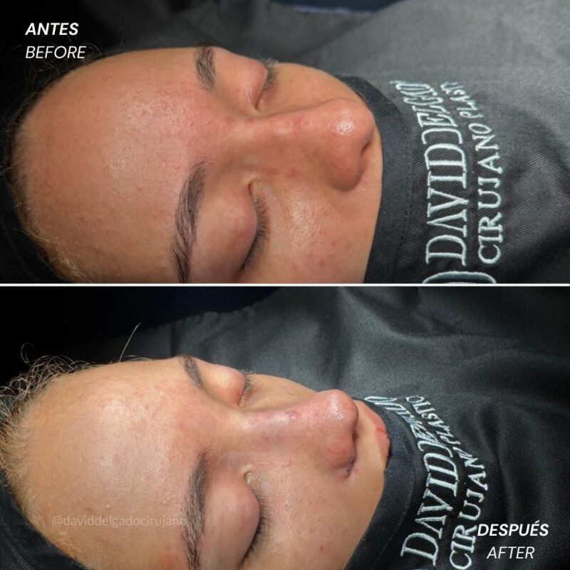 Antes y después Rinoplastia Ultrasónica Dr. David delgado Cirujano Plástico en Medellín