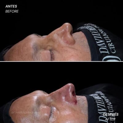 Antes y después Rinoplastia Ultrasónica Dr. David delgado Cirujano Plástico en Medellín