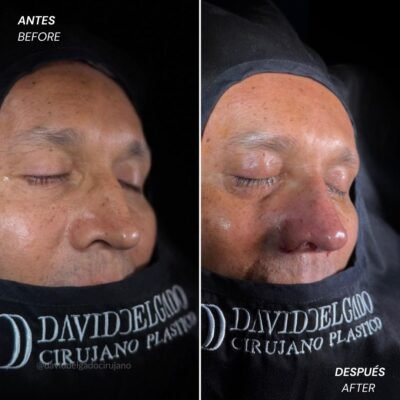 Antes y después Rinoplastia Ultrasónica Dr. David delgado Cirujano Plástico en Medellín